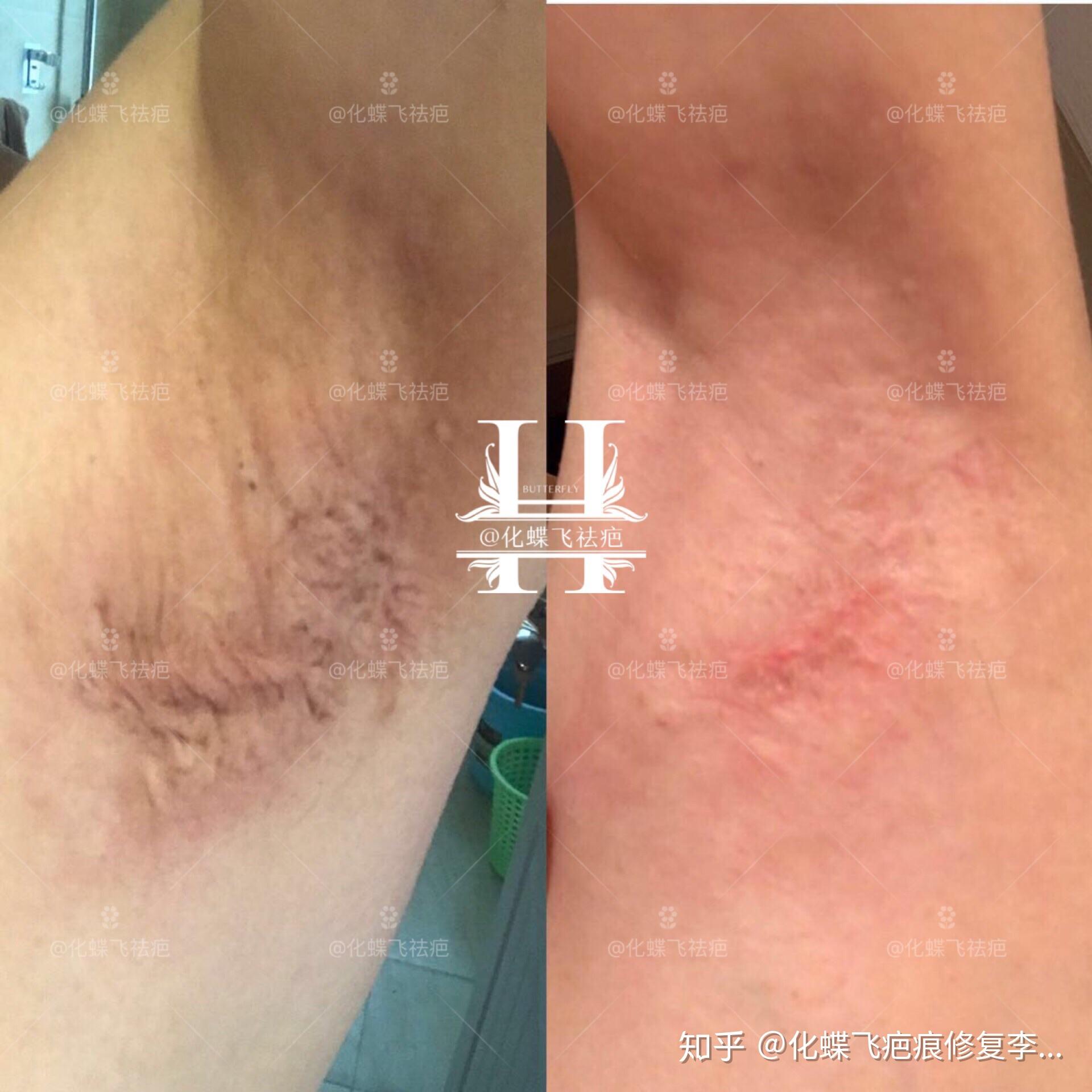 成都小姐姐的腋下手术疤痕中药修复恢复了80以上而且不复发