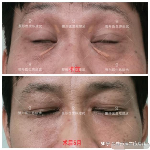 46歲男性大眼袋瞼黃瘤怎麼辦分享手術後5個月的變化照片