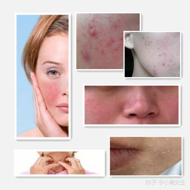 下图理肤泉的这款修复霜主打修护,针对皮肤干痒刺痛,起皮,泛红,痘痕