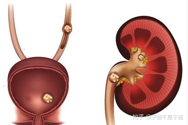 膀胱结石需要做哪些检查技术