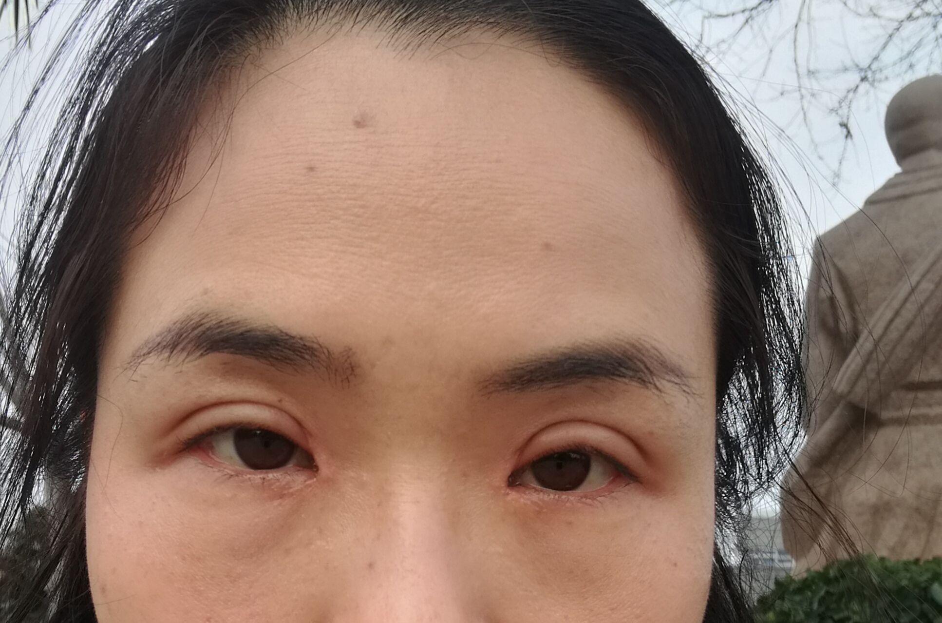 全切双眼皮做了提肌,开了眼角 现在快两个月了 感觉已经停止消肿了一