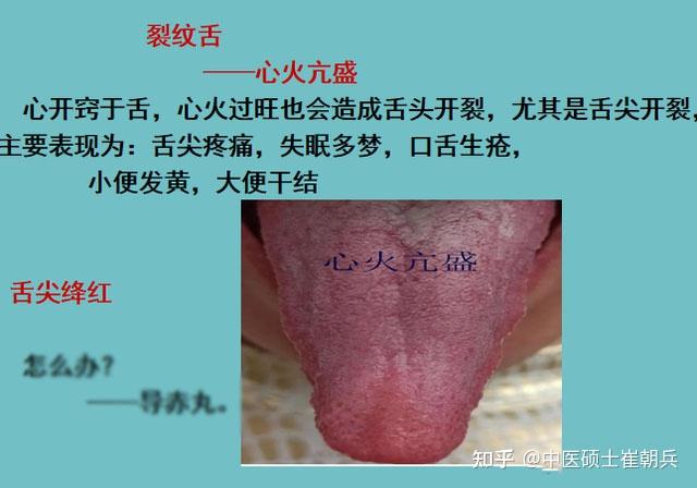 舌头有裂纹?5种原因,9种舌象,看看你是属于哪一种? - 知乎