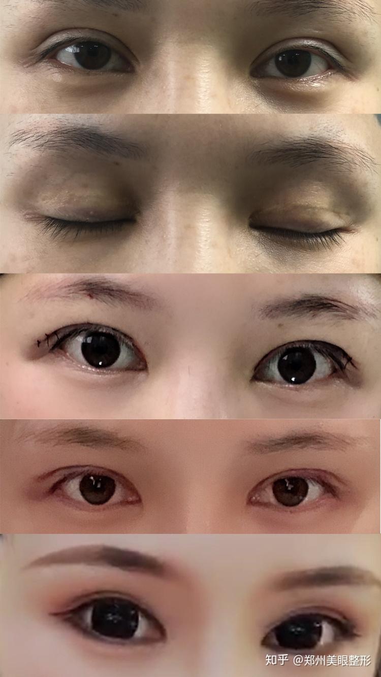 什么是双眼皮肉条感 v2-f010ea54313006c737dbdcdbaf657166_r.jpg