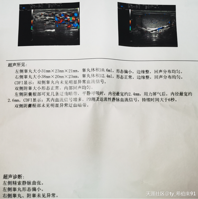 精索静脉曲张看了3个医生诊断经历(图) - 知乎