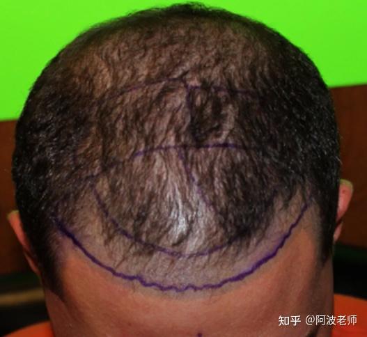 纹发后还能植发吗？ - 知乎