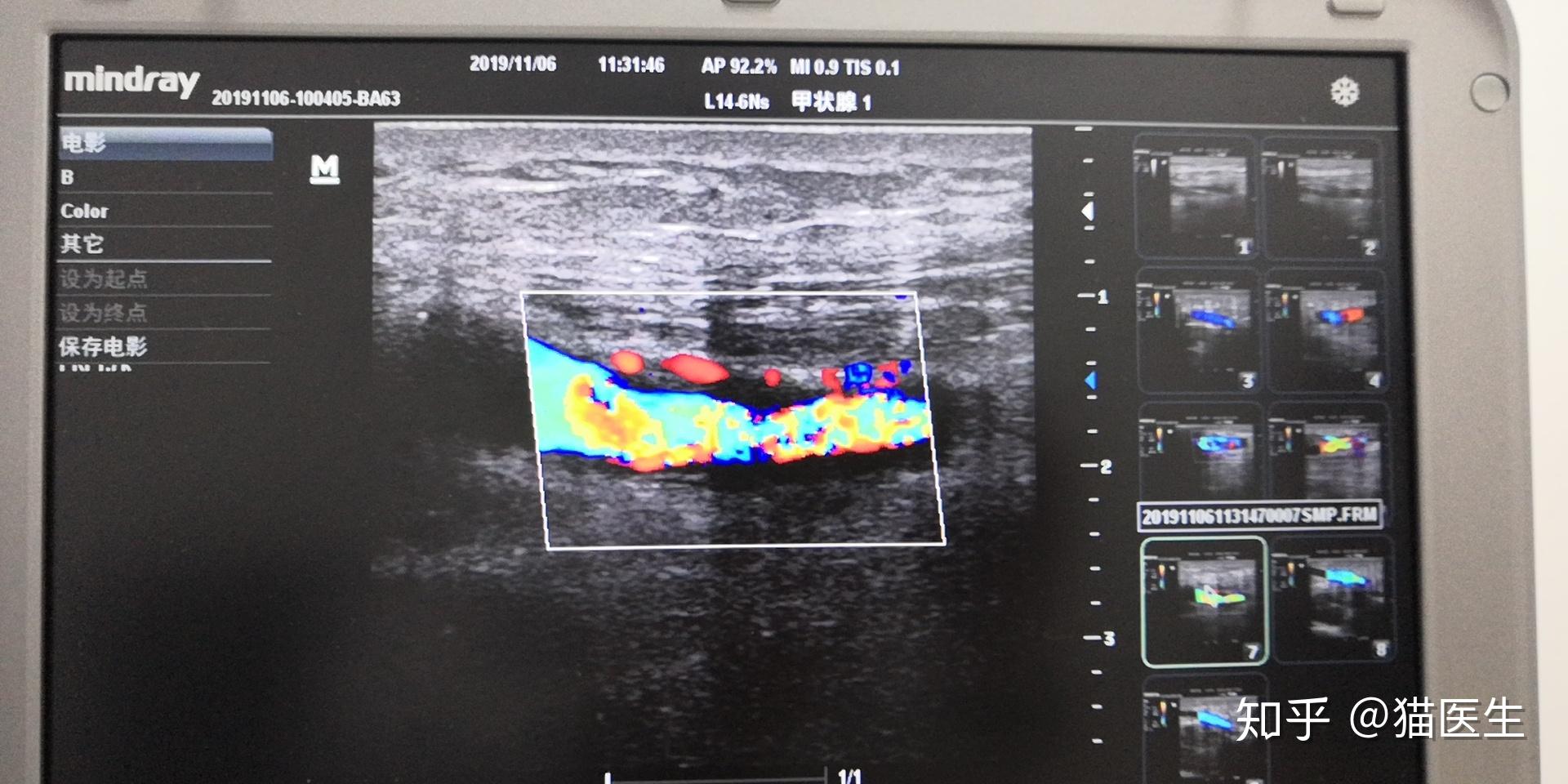 优化设计方案治疗头静脉弓狭窄闭塞
