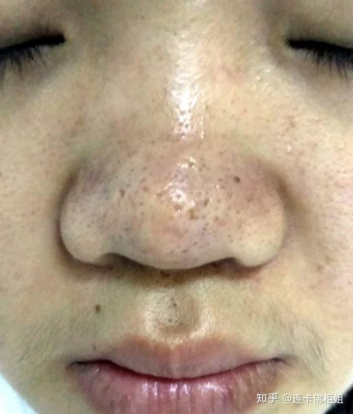 初二皮肤不是很好 毳毛很多 怎么去除?