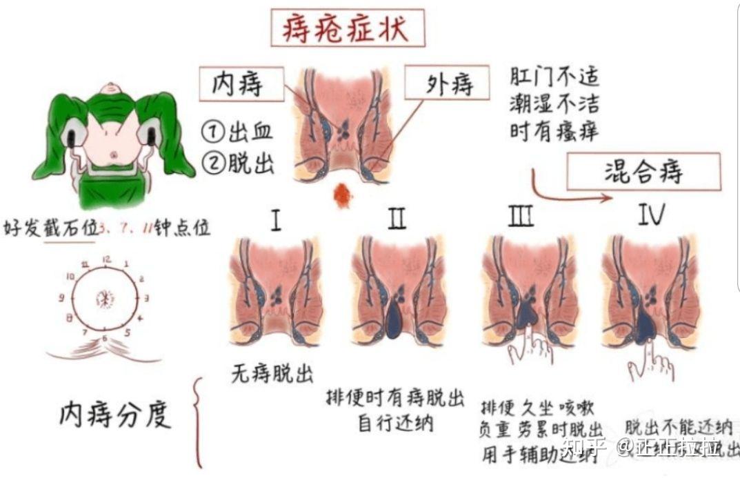 痔疮怎么消除最快方法图片