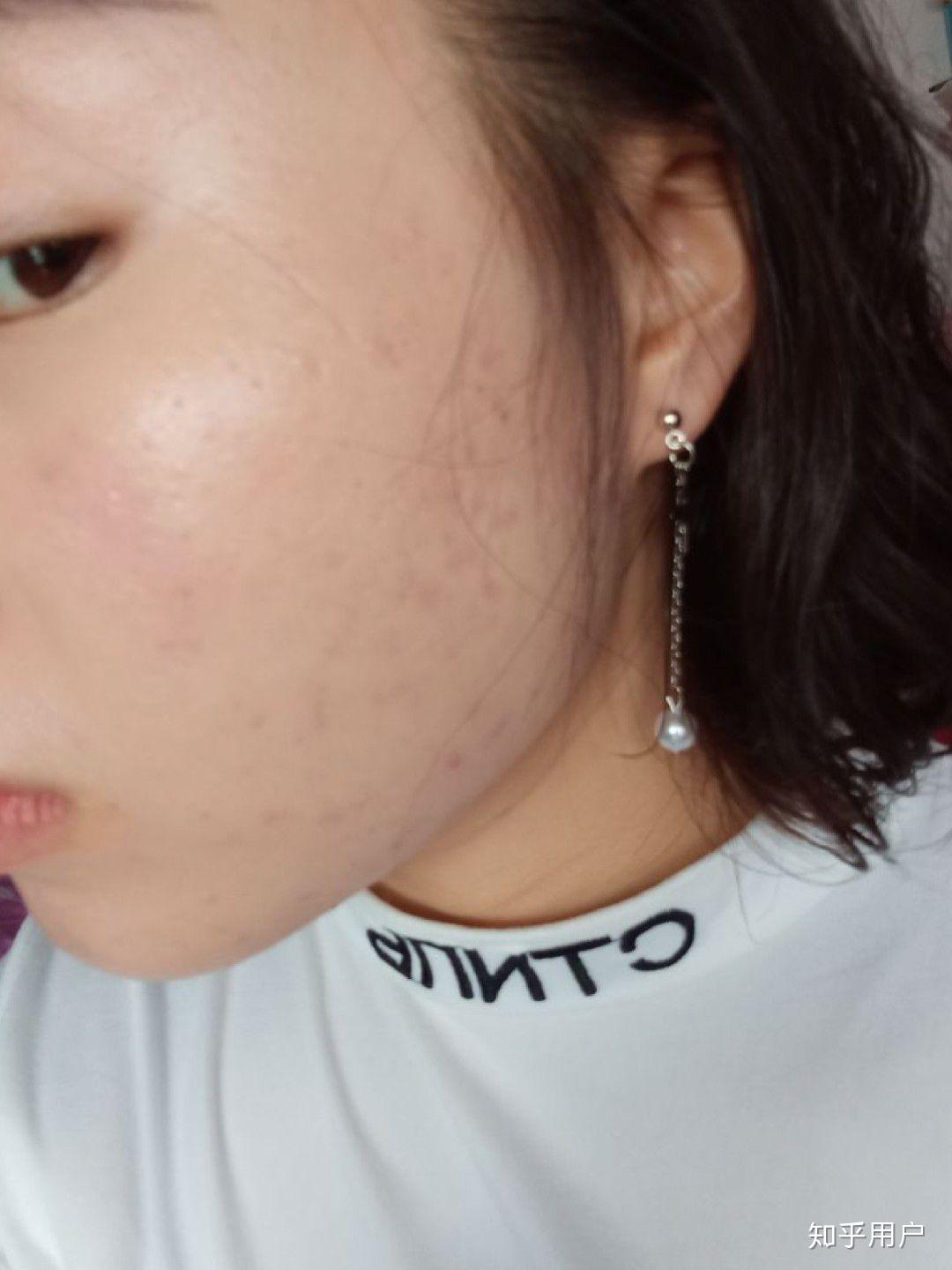 我的痘印两年了有点红褐色还能去除吗求你了各位哥哥和姐姐我17难道