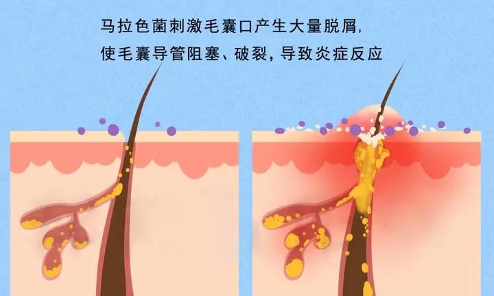 如何治疗头皮问题?蓝极光来帮忙 - 知乎