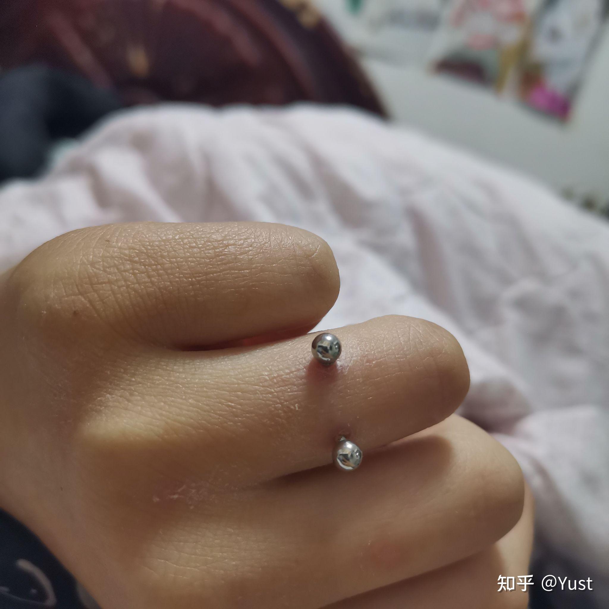 手指钉orward helix恢复记录 - 知乎