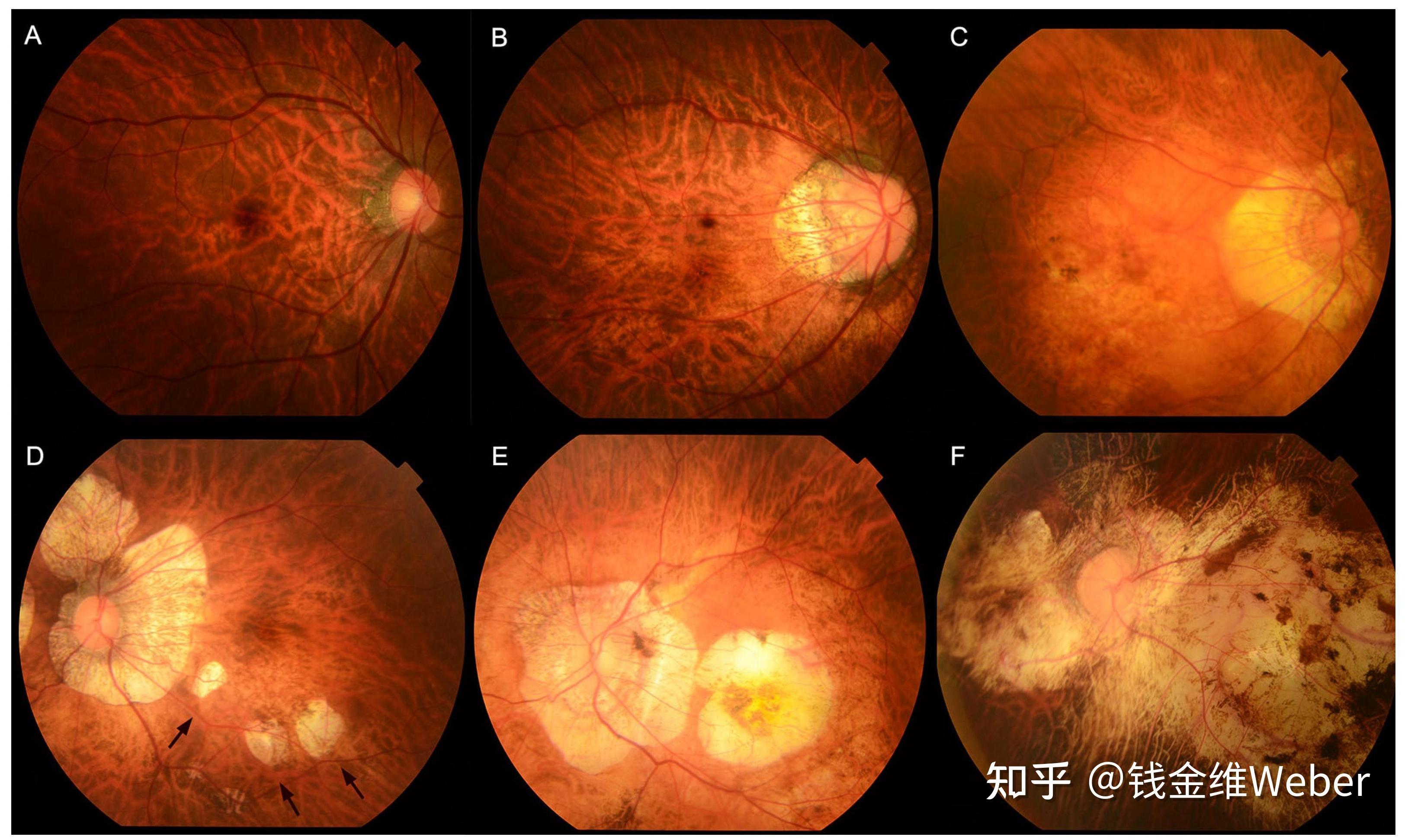 高度近视随着年龄增大眼底病变愈发严重的概率大吗? - 知乎