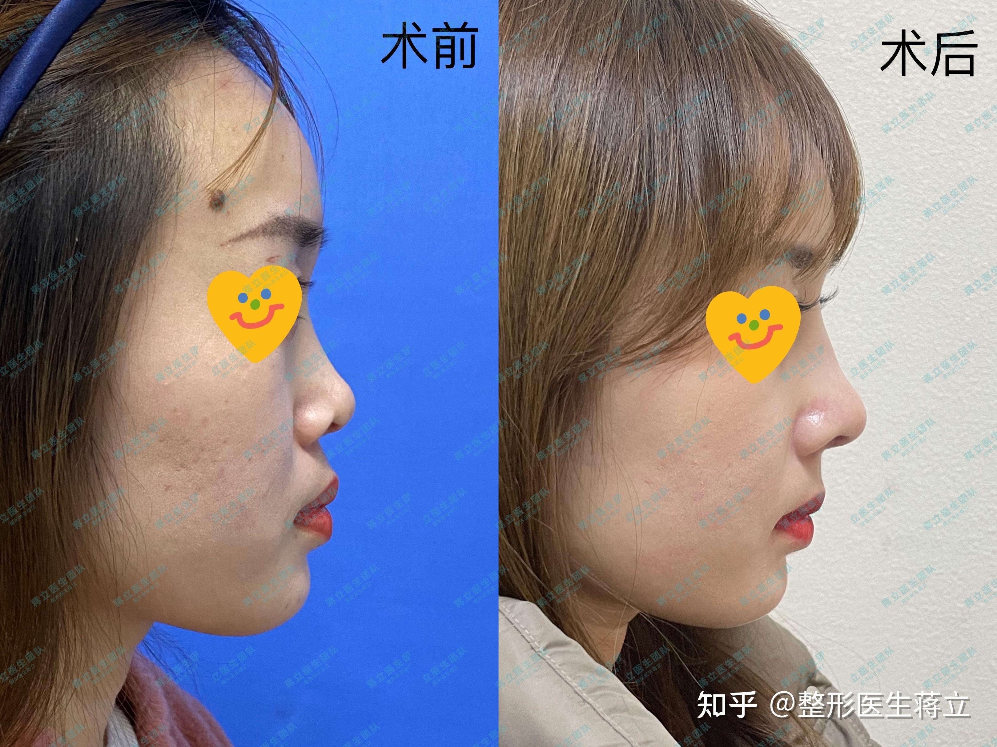 鼻头鼻翼缩小,鼻小柱延长,垫鼻基底做这三项鼻综合的费用大概是多少?