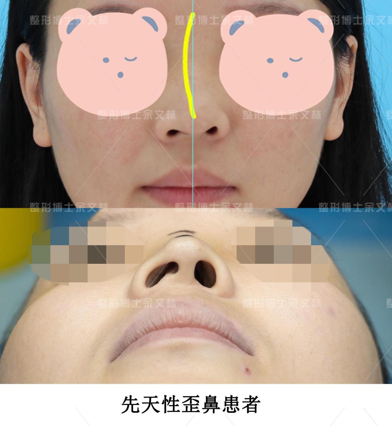 鼻综合（垫高鼻梁、福鼻矫正、鼻翼缩小）手术前_整容通