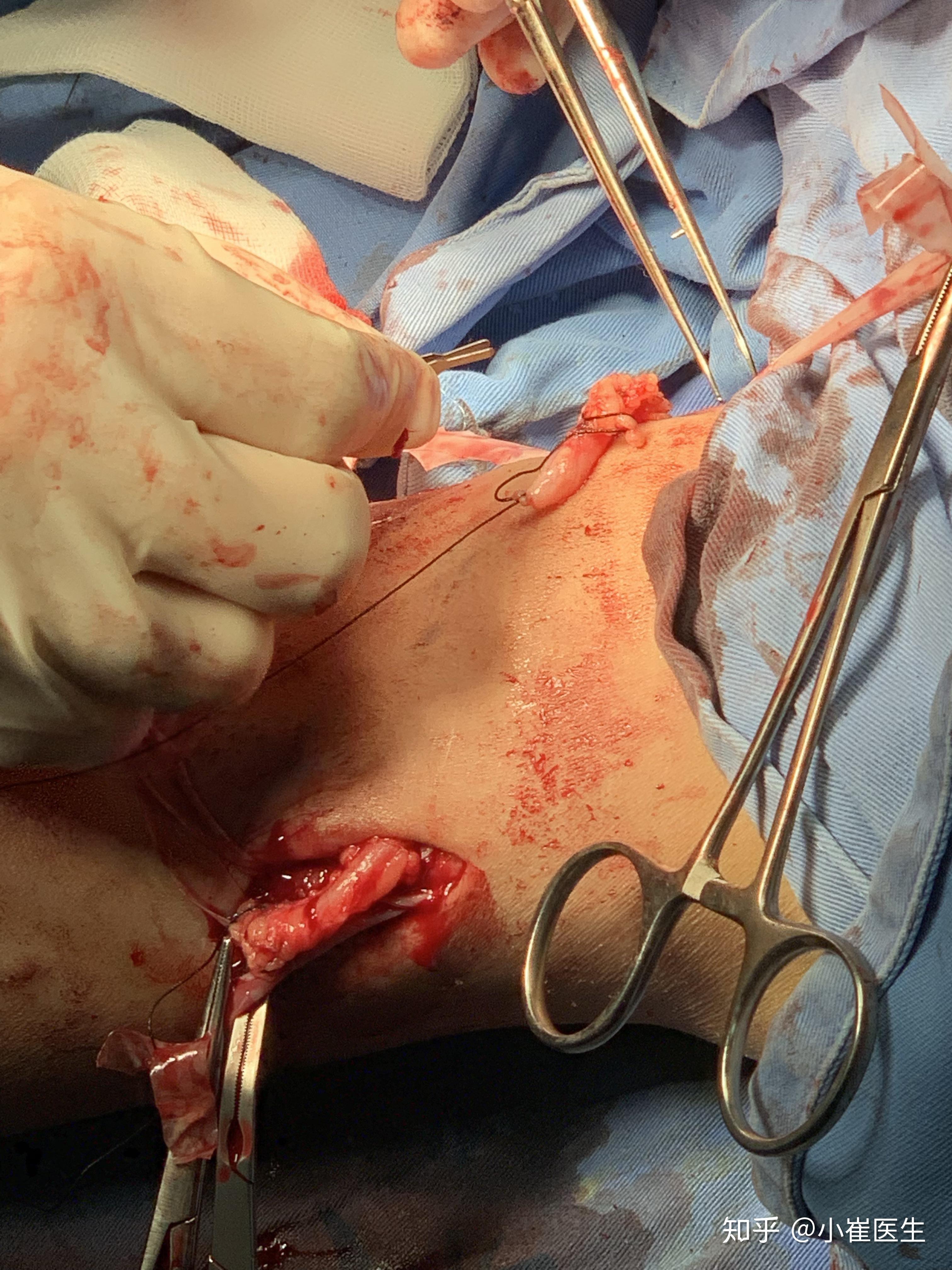 自体大隐静脉移植重建静脉流出道—病例分享