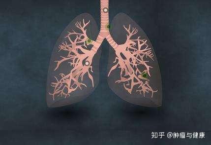Ct中发现了肺部有肿块 会是肺癌吗 如果是这几种情况就不必担心 知乎 Ct中发现了肺部有肿块 会是肺癌吗 如果是这几种情况就不必担心 知乎