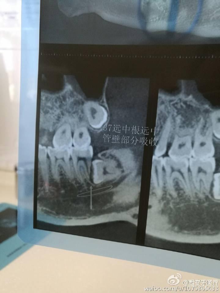 你经历\/听说过不拔智齿造成的严重后果?