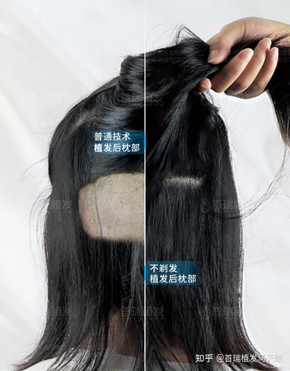 植发一定要剃头发?完全不剃发如何做到“一根头发不剃”......