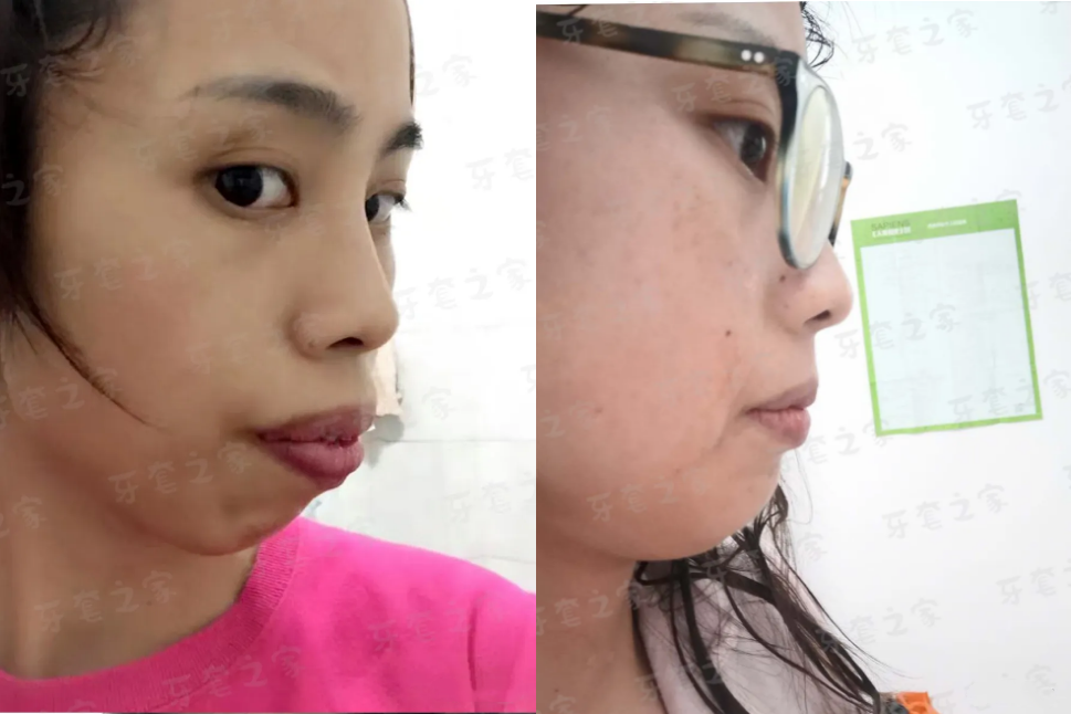 家族遗传骨性龅牙咬合不正常拔8颗牙正畸后从超级严重龅牙妹变成了