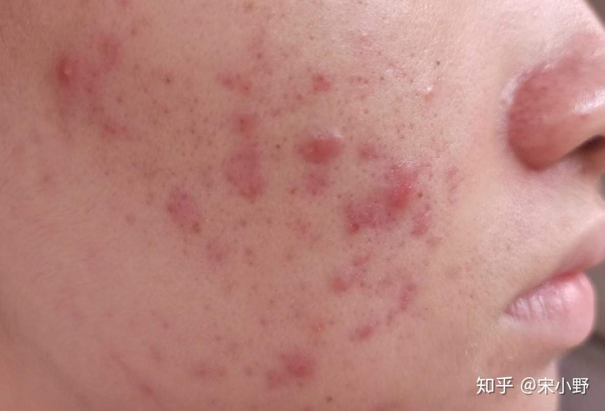 我脸上的红色痘印七八个月了，一直不下去，我该怎么办。？ - 知乎