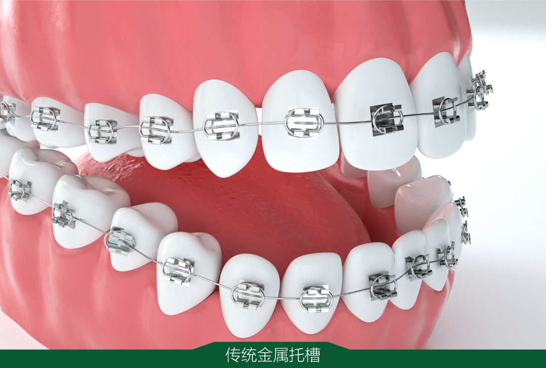 正畸季丨【隐形矫正可能更适合你】在有些问题上成年人不一定选择全都要...... - 知乎