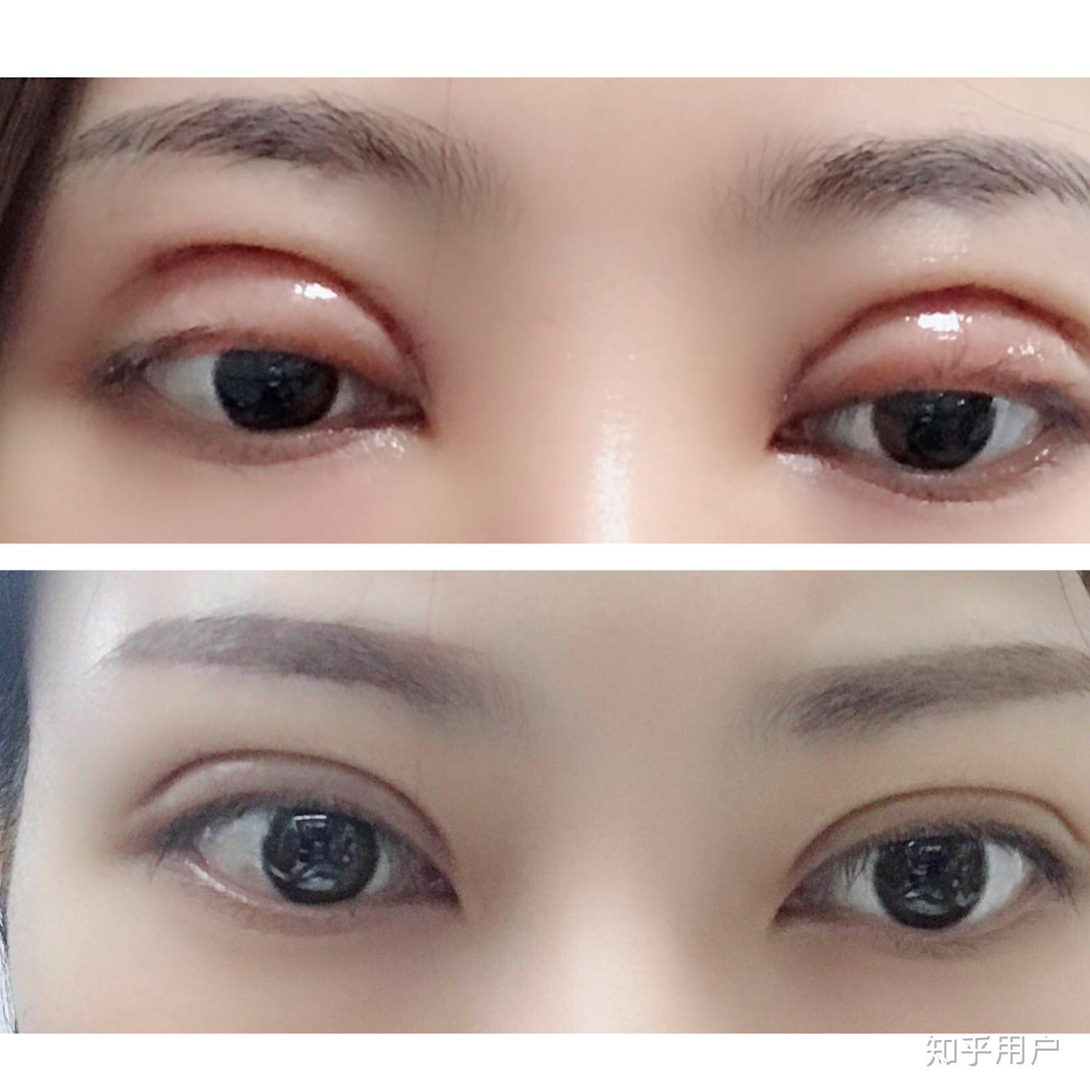 怎么判断双眼皮是肿还是肉条?