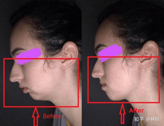 张嘴呼吸面容变丑能恢复吗?