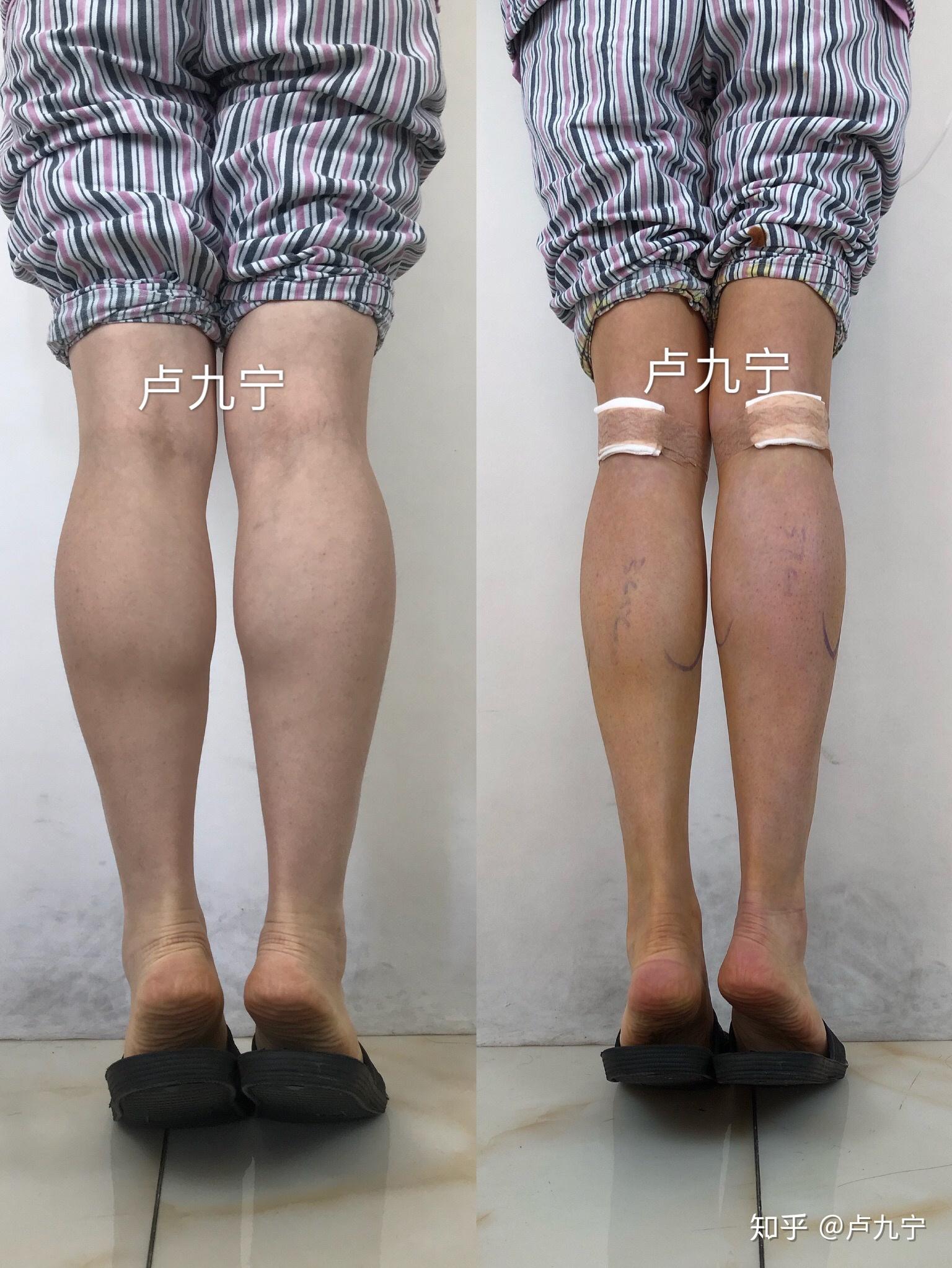 术后胫骨外翻（也称X型腿）的纠正与治疗（附动作视频） - 知乎