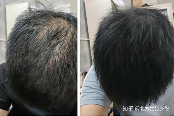 吉荷堂生发真实有效吗，且看我的生发妙方。 - 知乎