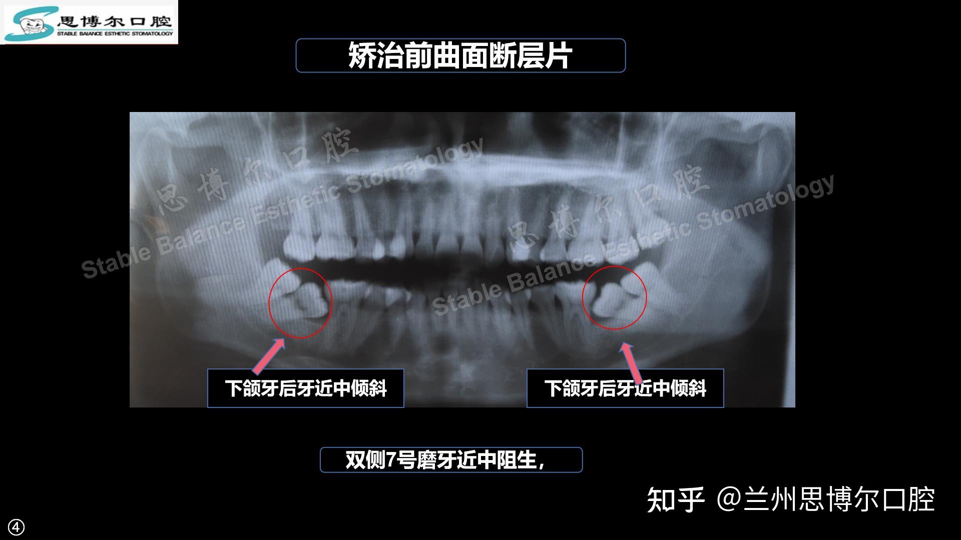 下頜雙側第二磨牙近中傾斜矯治案例