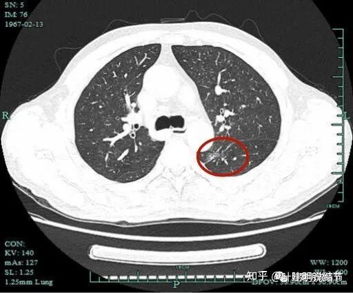 平掃非薄層:影像展示與分析:檢查發現左肺下葉結節一年許,沒有明顯