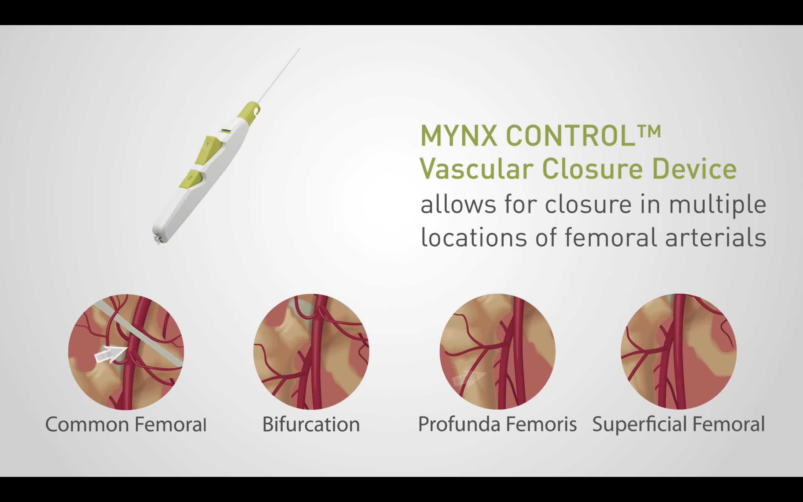 【行业资讯】MYNX CONTROL静脉闭合器 - 知乎