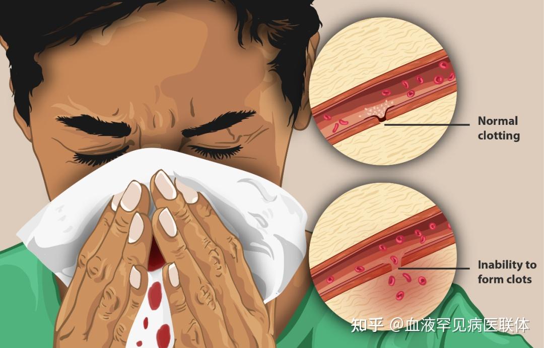 血友病的主要症状就是"容易出血",但并非所有"容易出血"都是血友病