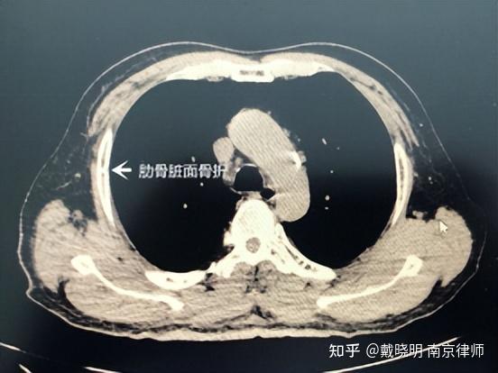 1,市中心醫院ct會診診斷報告書記載:(二)被害人右側肋骨骨折為直接