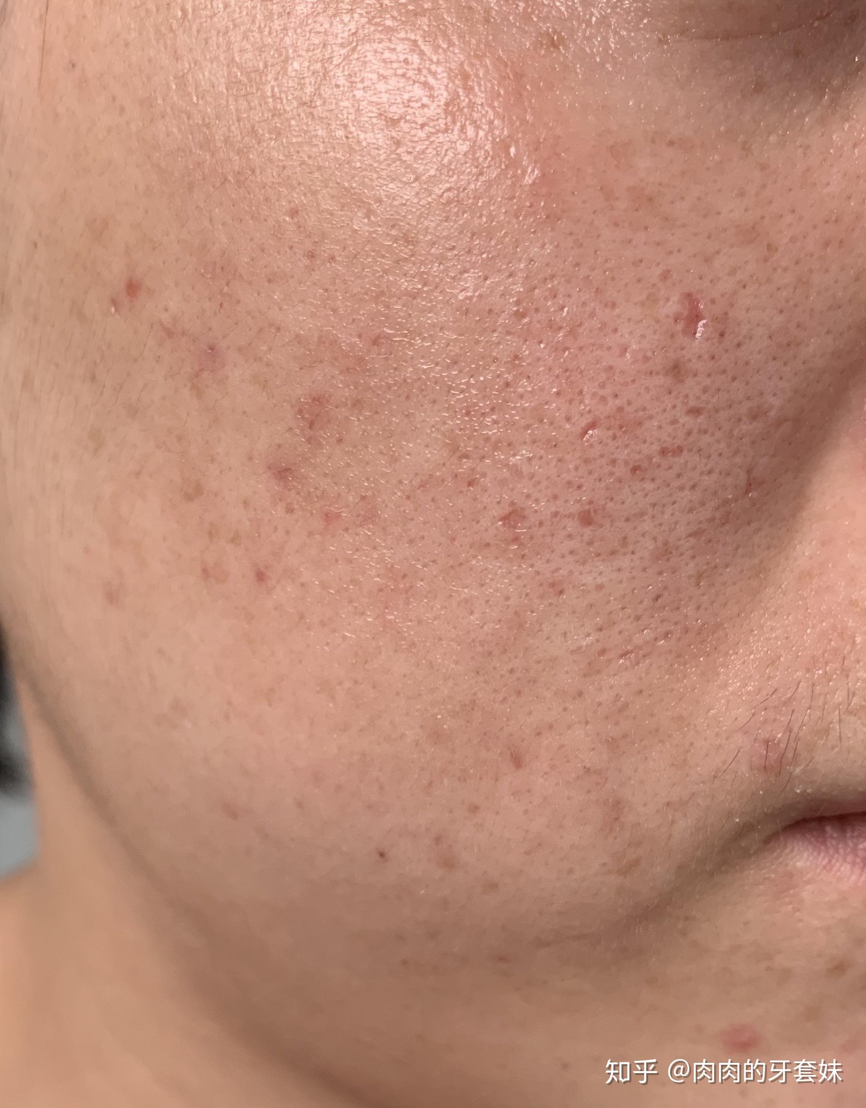 痘坑持续抗战微针