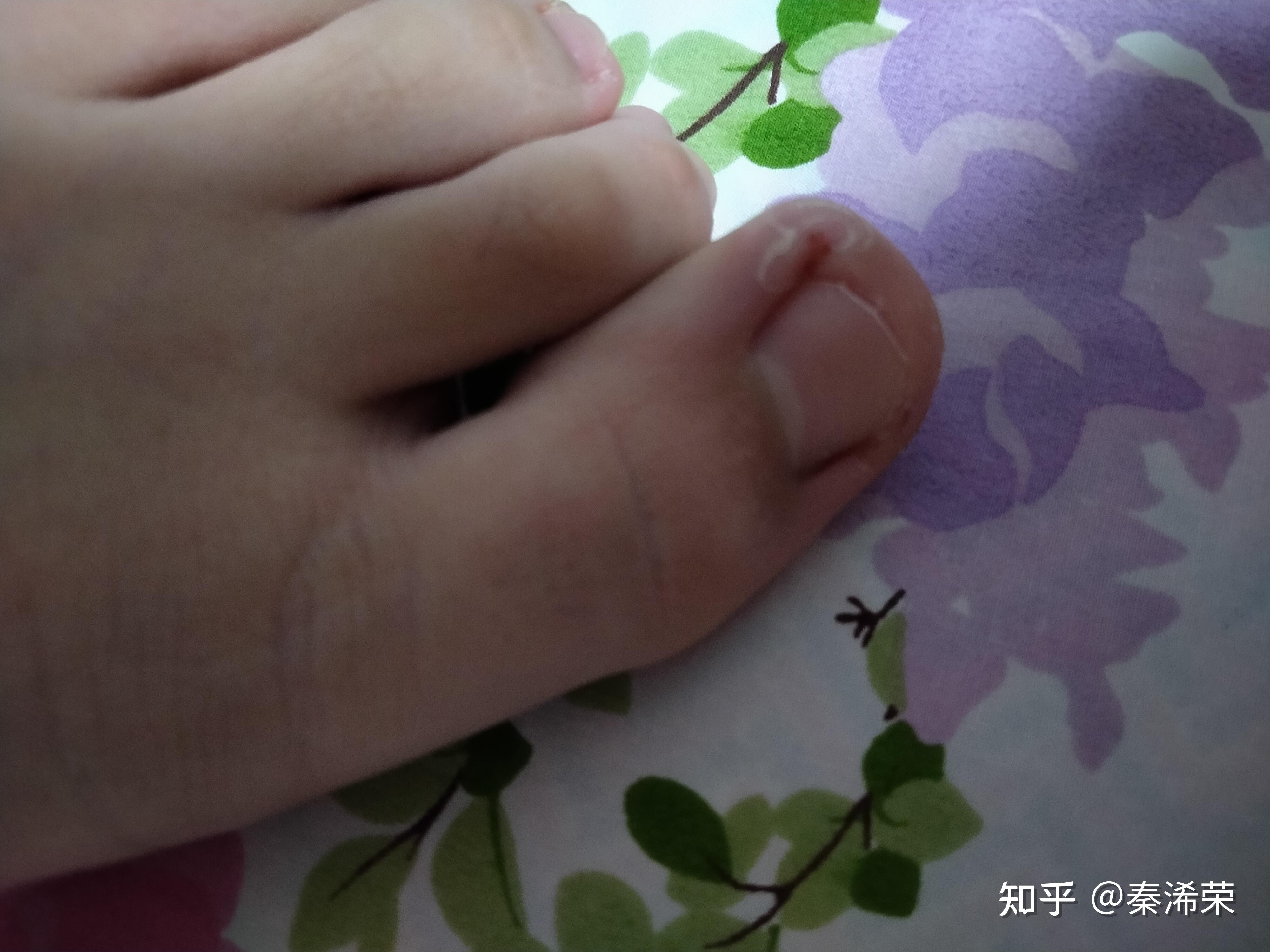 大脚趾甲有一条特别深的横纹,看起来跟裂开了一样,想请教一下这是怎么