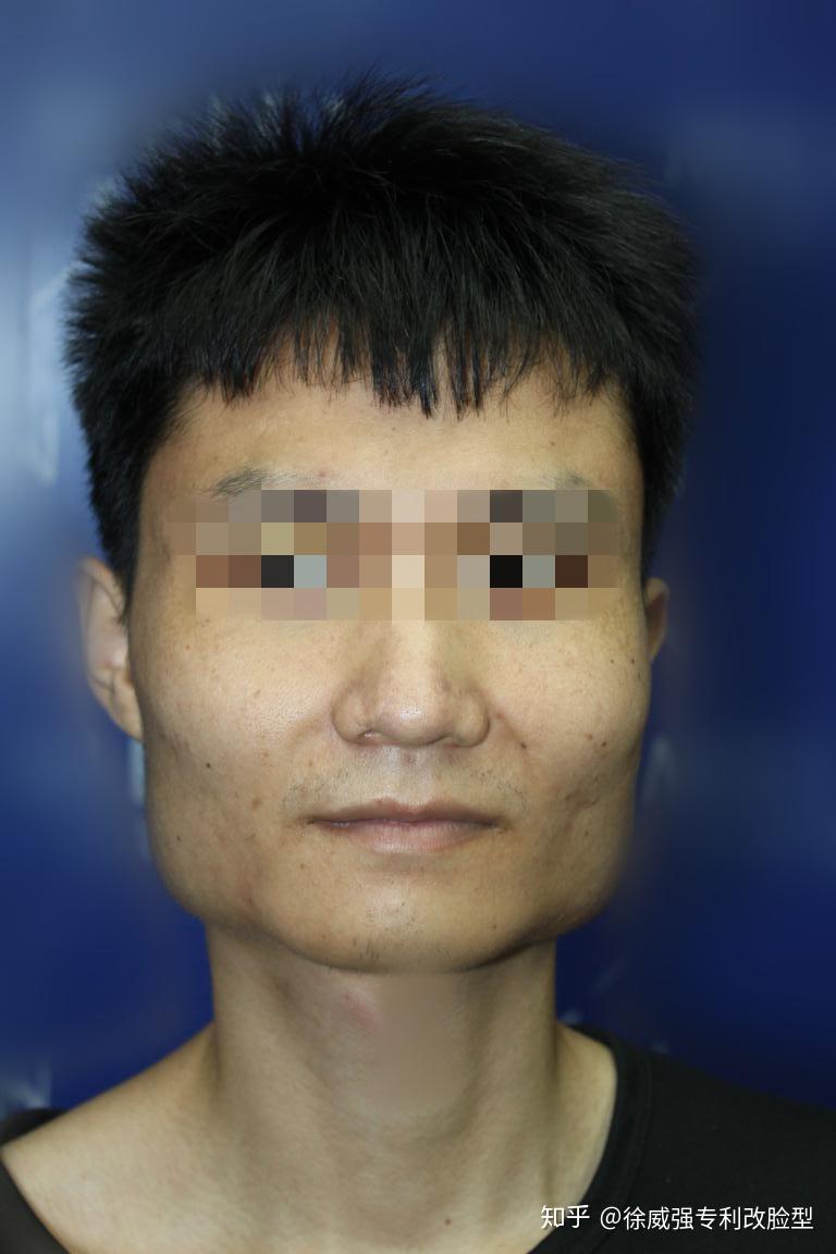 我一个男生想去削骨可以吗