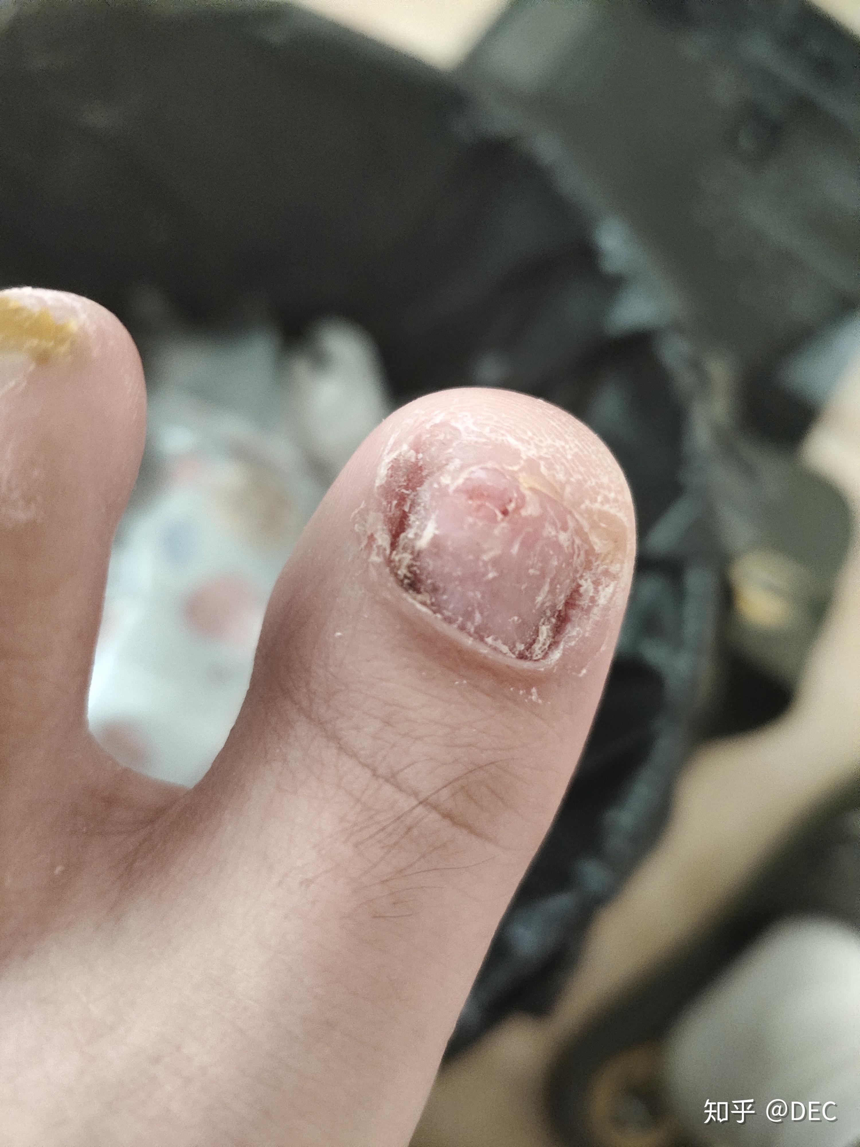 因为我右脚有4个脚趾是轻微症状,脱甲精油对此也不太有效,所以这4个