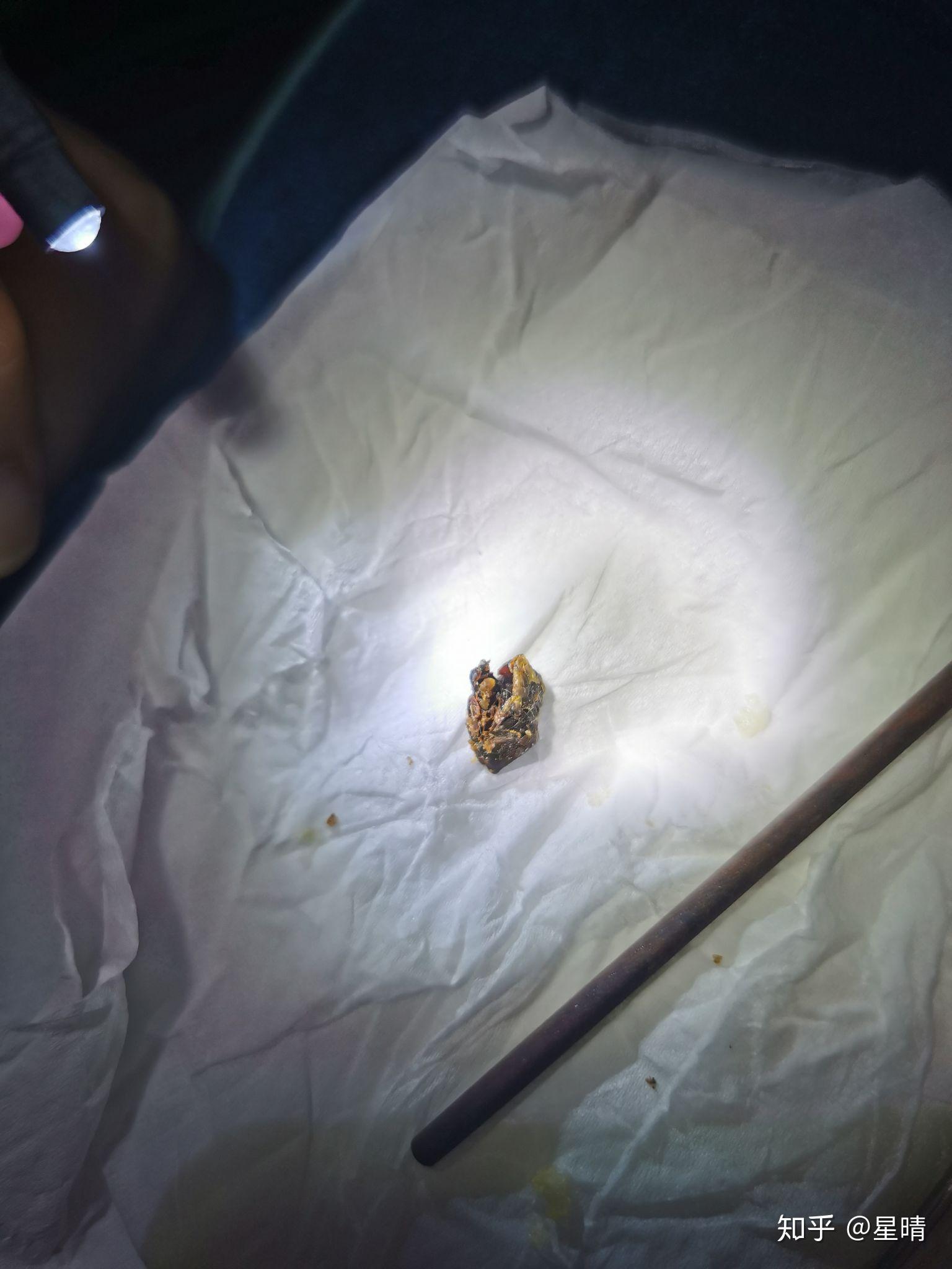 真的有"耳结石"这回事吗? - 知乎