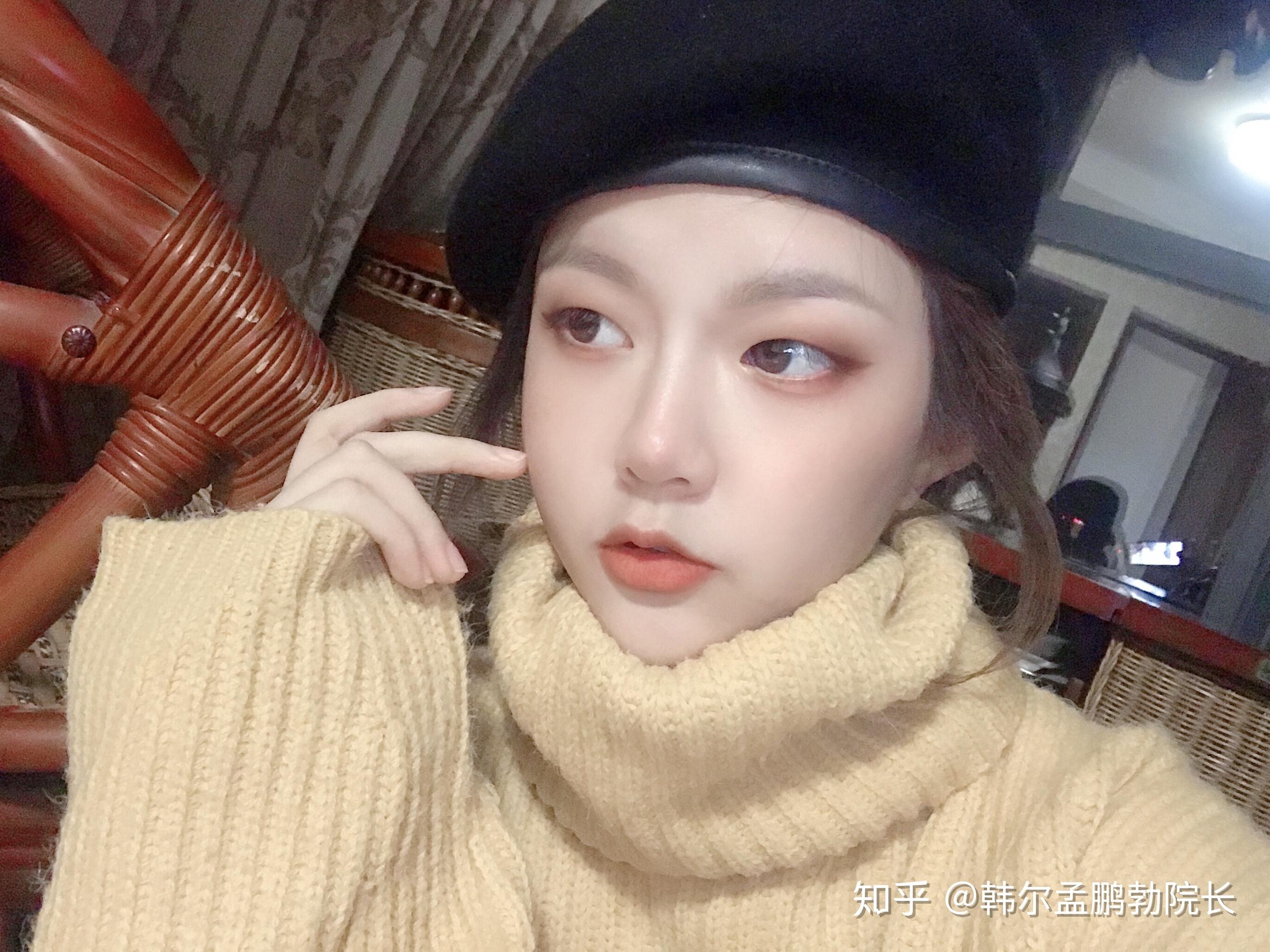 在福州韩尔做了隆鼻甩掉了又圆又钝的鼻头