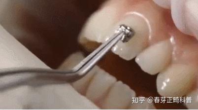 牙齿脱矿了怎么回事能治吗? - 知乎