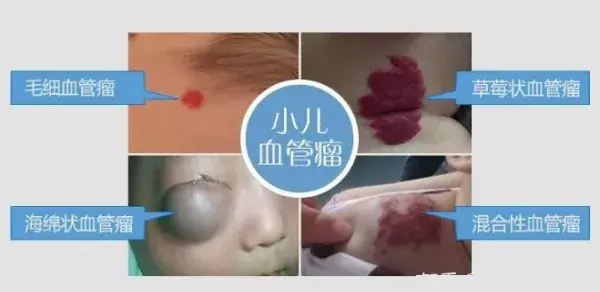 “上辈子留的记号”你都会认吗?深扒胎记真相! - 知乎