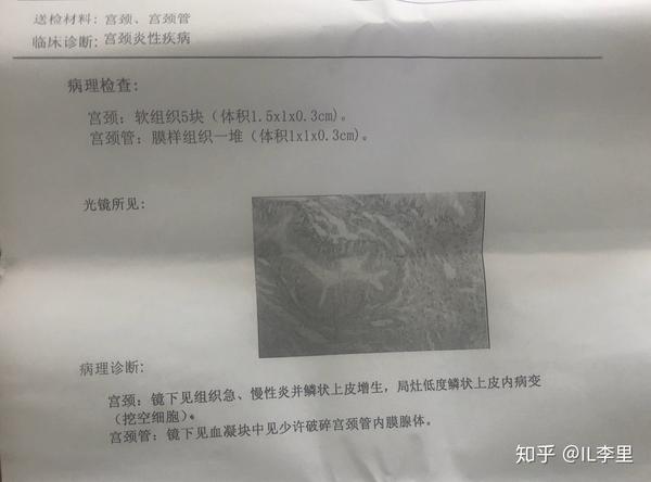 hpv16陽性宮頸糜爛三度tct陰性陰道鏡活檢局灶低度鱗狀上皮內病變我要