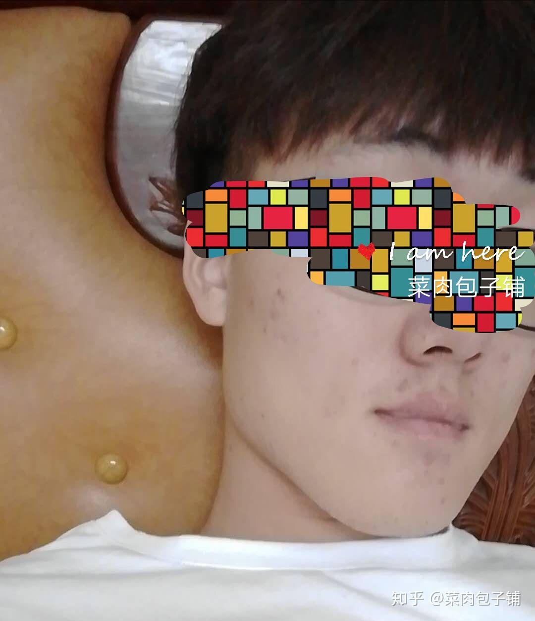 如何去除脸上的痘印、痘坑?