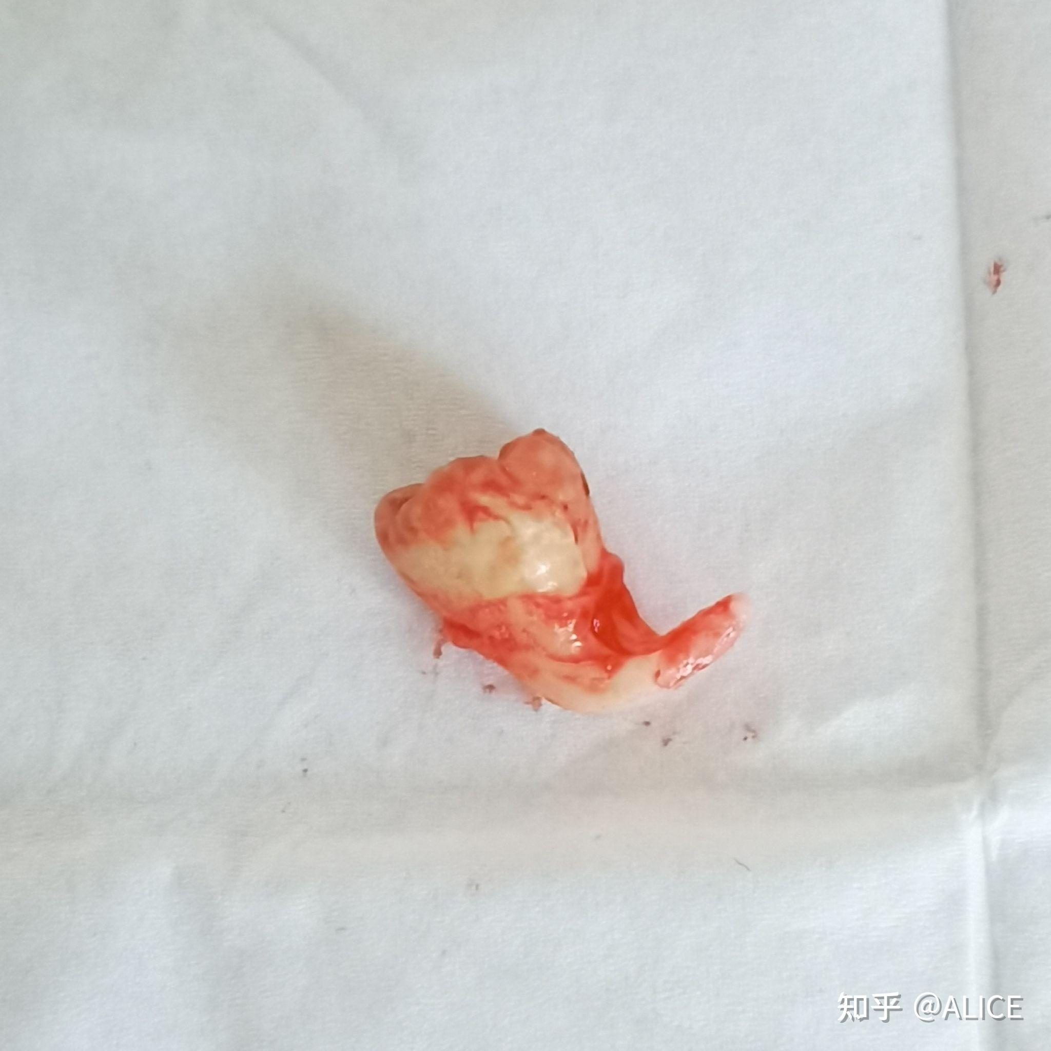 智齿牙根弯曲成鱼钩状能不能拔