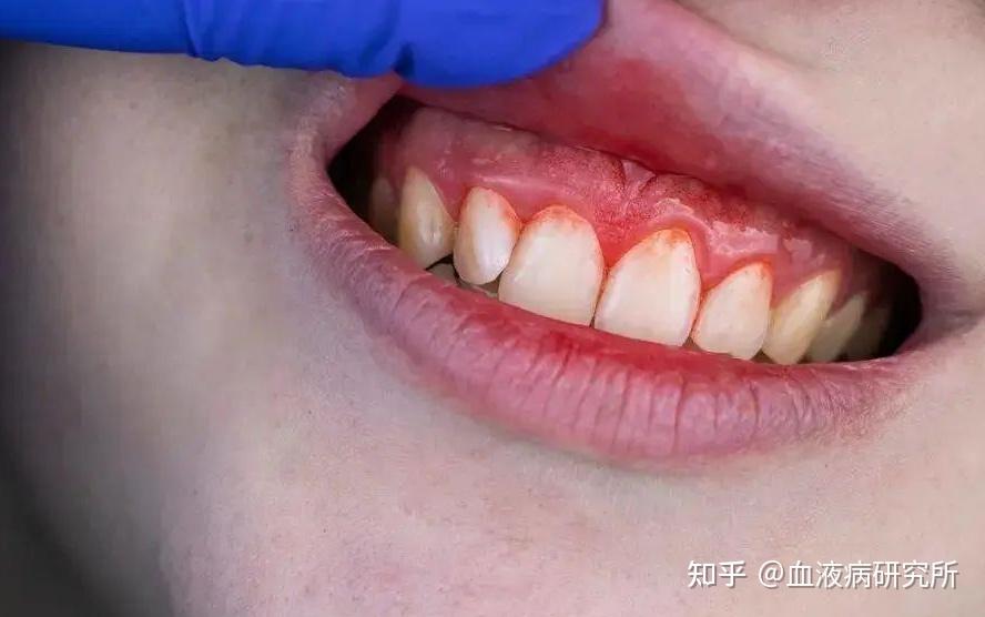 牙龈出血是什么病啊?