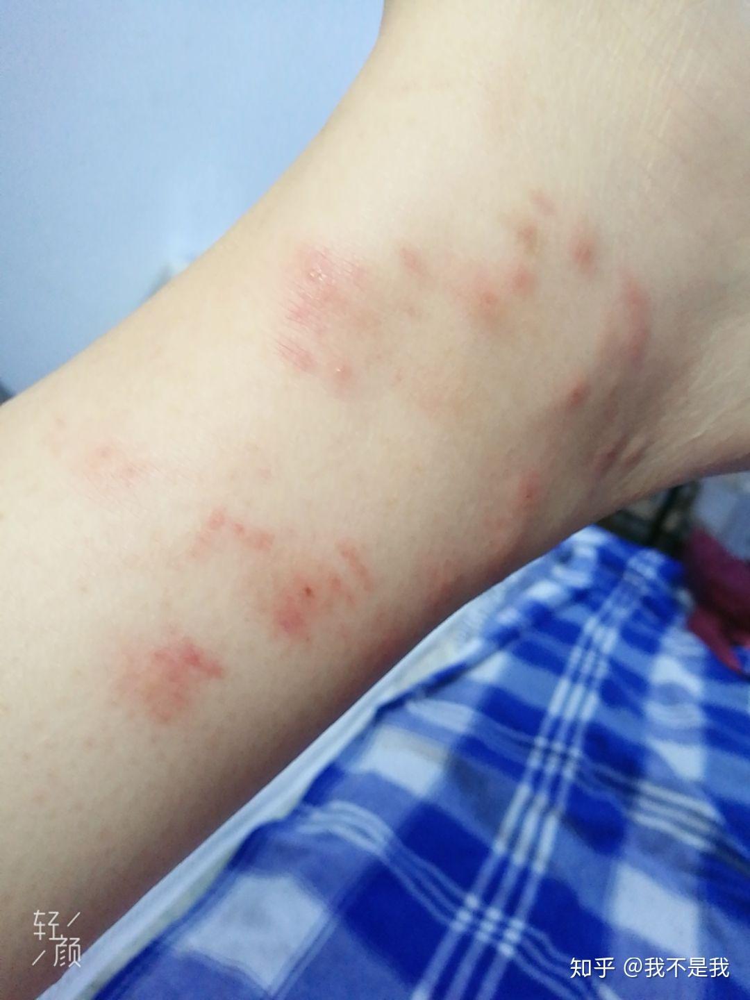 每天被蚊子叮十多个包是怎样一种体验? - 知乎