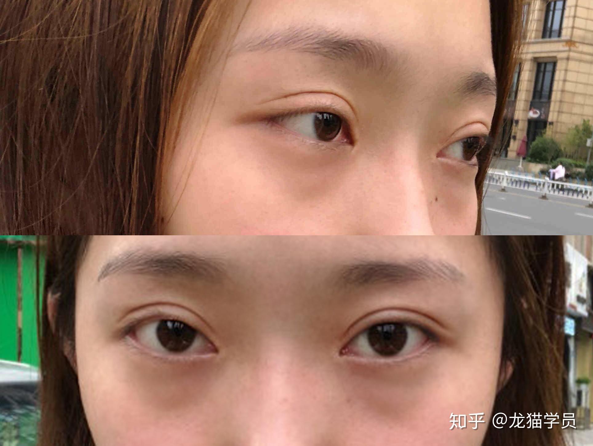 术前情况:脂肪型眼袋 黑眼圈,无明显泪沟凹陷大多数年轻人手术祛眼袋