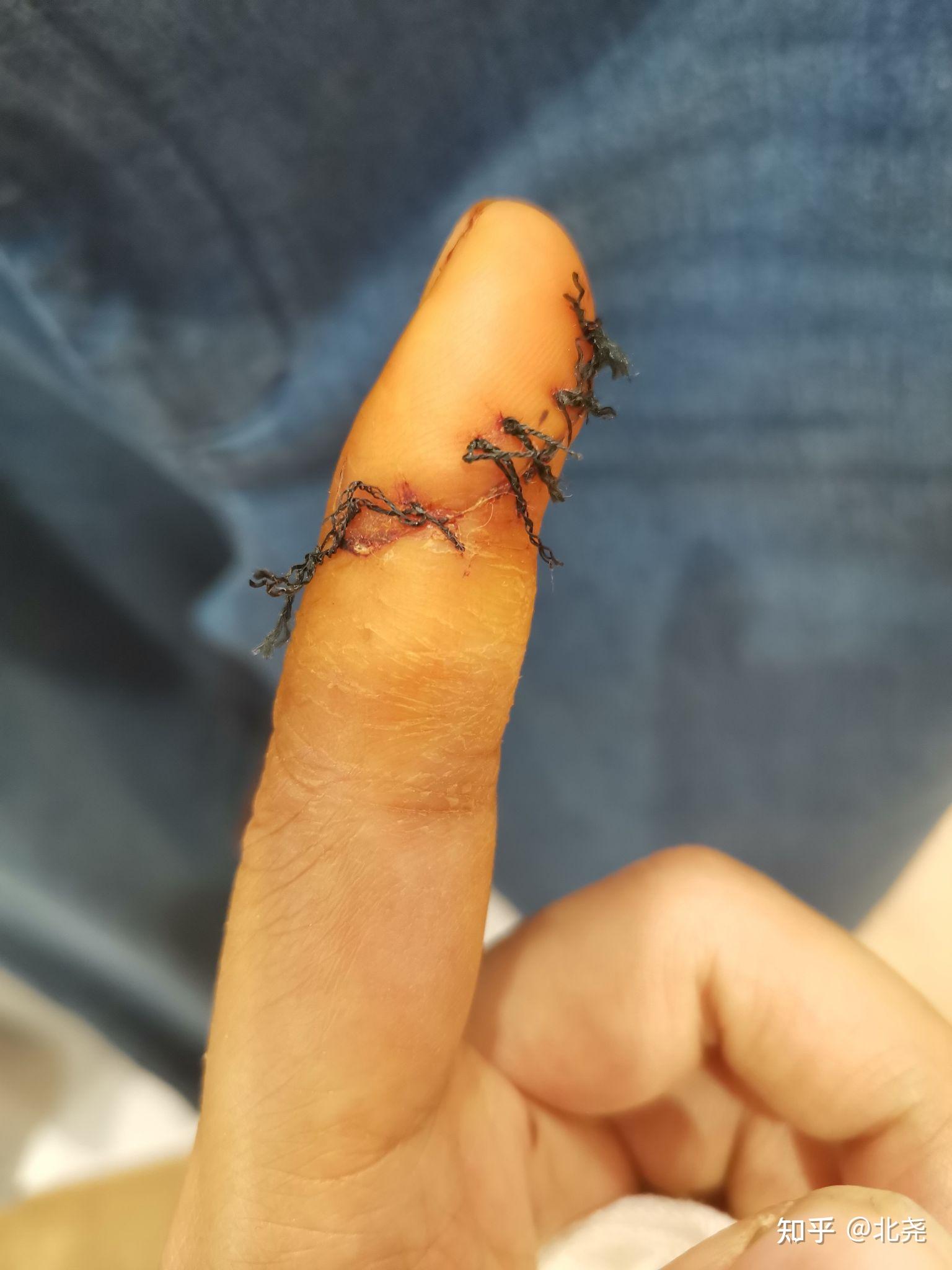 手指肌腱神经断裂需要多久恢复?术后9天手指还肿正常吗? - 知乎