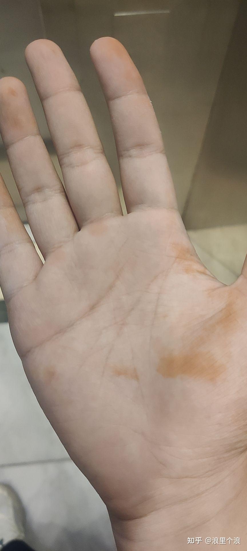 一觉醒来手上有铁锈一般的黄色块洗不掉?